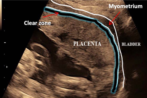 Placenta Accreta Spectrum Fmf Courses