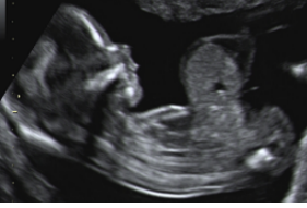 The 11-13 weeks scan - FMF Courses