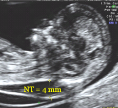 The 11-13 weeks scan - FMF Courses