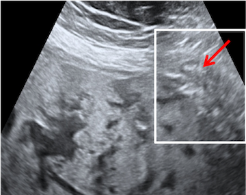 Placenta Accreta Spectrum - FMF Courses