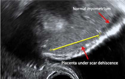 placenta accreta ultrasound