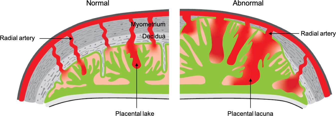 Definition Of Placenta Accreta Spectrum